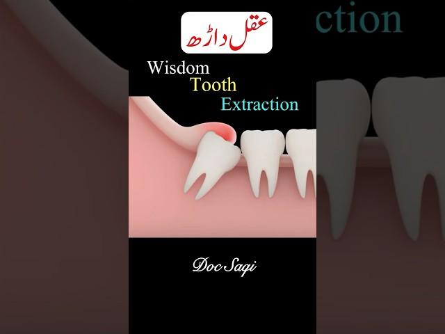 Wisdom tooth Extraction| #wisdomtooth #toothextraction #healtheducation #shorts #dentist #health
