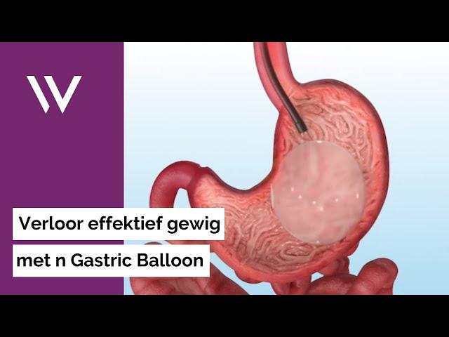 Die Maagballon prosedure: 'n Nie-indringende versneller om jou gewigsverlies doelwit te bereik.