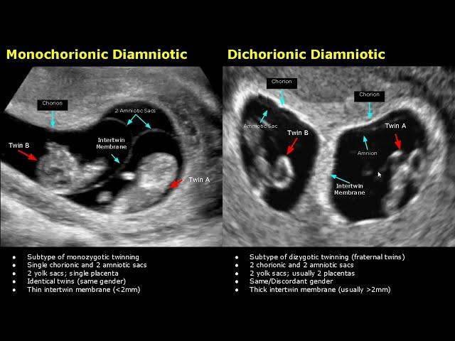 Fetal Twins Ultrasound Normal Vs Abnormal | Monochorionic/Dichorionic/Diamniotic/Monoamniotic USG