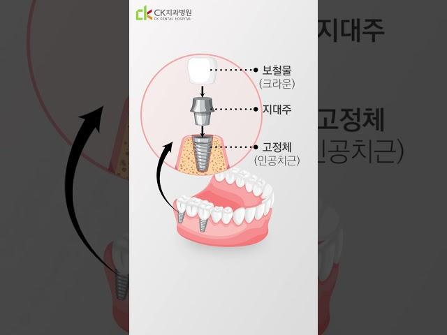 [치아상식] 구조로 알아보는 임플란트! #shorts