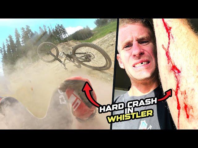 HARD CRASH ON MY DOWNHILL BIKE IN WHISTLER BIKE PARK!