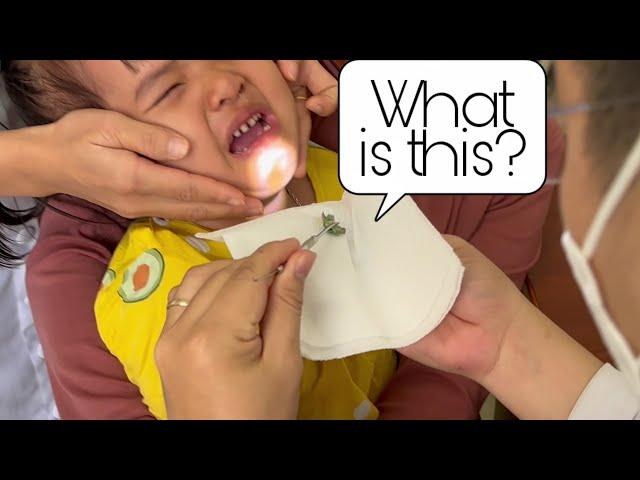 A child PUT candy wrapper into nose | Foreign body removal | Doctor Anh