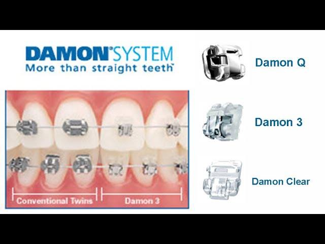 Damon Clear Braces จัดฟันดามอน | www.bangkokbraces.com