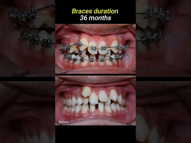 Braces for crowded teeth #braces #orthodontist #dentistry #dentist