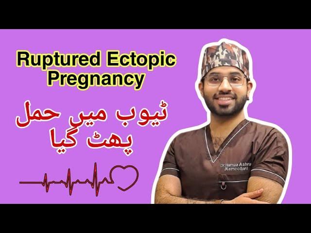 Ectopic Pregnancy| Tube Main Haml Phat Gya|Dr Hamza Ashraf