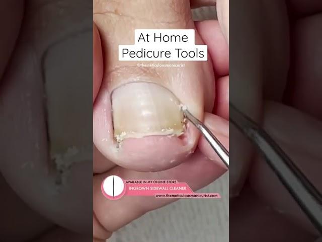 At Home Ingrown Toenail Relief