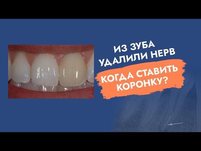 Из зуба удалили нерв. Когда ставить коронку?