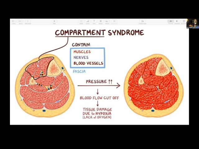 Fundamentals of Orthopaedics Session 14 Part 2 - Compartment Syndrome