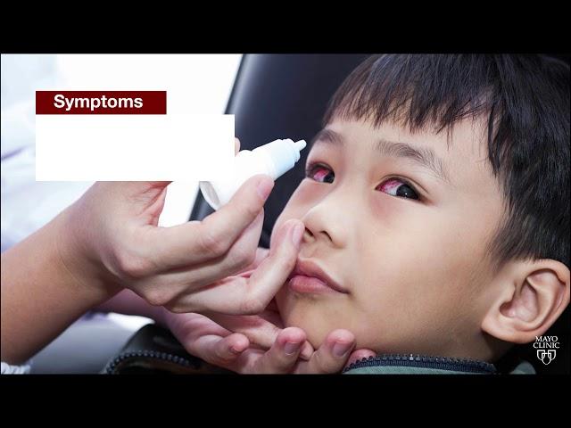 Mayo Clinic Minute: What parents need to know about pink eye