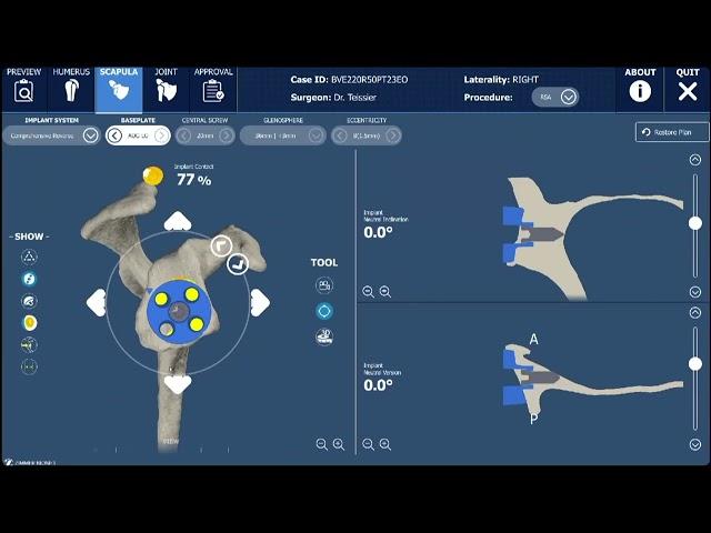 PLANIFICATION PRE-OPERATOIRE DE PROTHESE - EPAULE / OrthoSud Montpellier