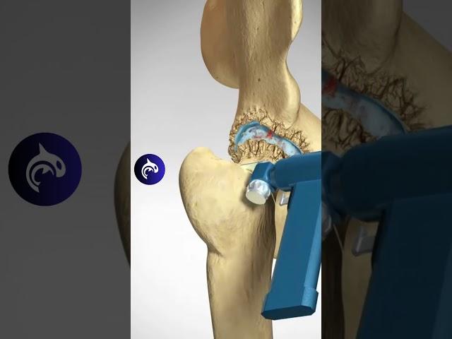 Total Hip Replacement (Arthroplasty) - 3D Animation