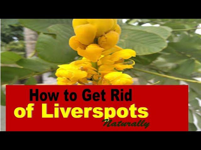 No More Liverspots with This Plant: Medicinal Plant Series - #3