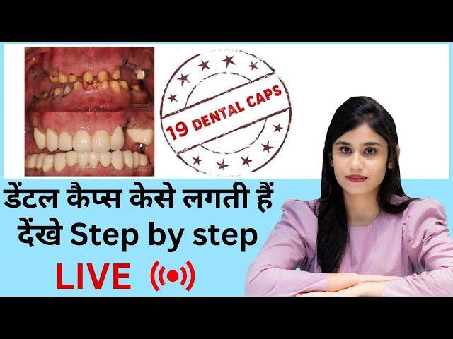 19 Dental Cap live procedure by Dr Vishakha Jain | Seraphic Dental Indore | Best Dentist in indore