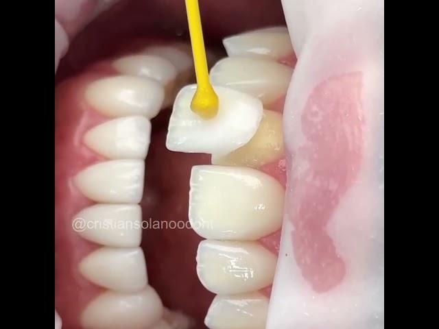 Veneers #dentist #dentalcare  #veneers #dentalsmiledesigning #shorts