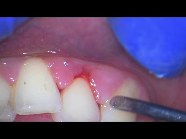 Ultrasonic teeth cleaning (watch why your gums bleed)