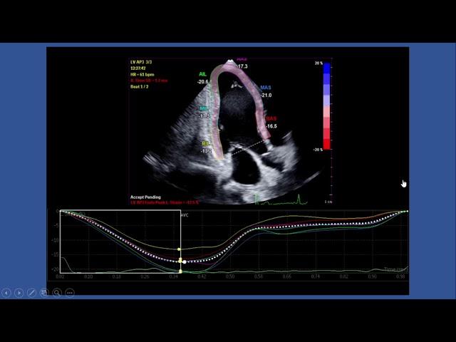 Strain Echocardiography by speckle tracking and tissue Doppler -Part I:technique