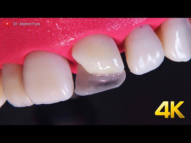 AMAZING fractured tooth restoration in 4k