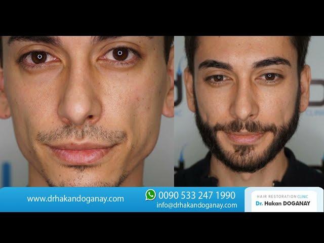 2800 Grafts Beard Transplant Before and After I Dr. Hakan Doganay TURKEY