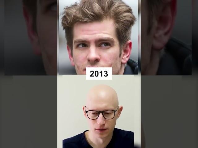 Did Andrew Garfield get a Hair Transplant?