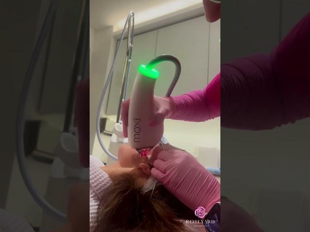 MOXI treatment #sciton #moxi