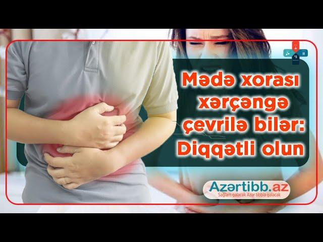 Mədə xorası xərçəngə çevrilə bilər:Diqqətli olun