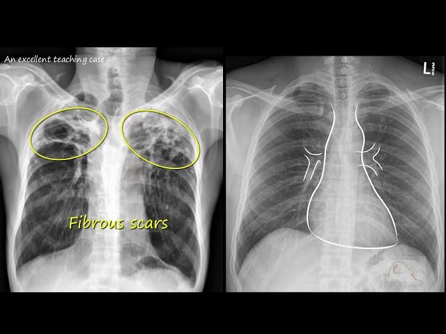 Chest  x ray  -   Tuberculosis healed,  (TB),   Inactive TB