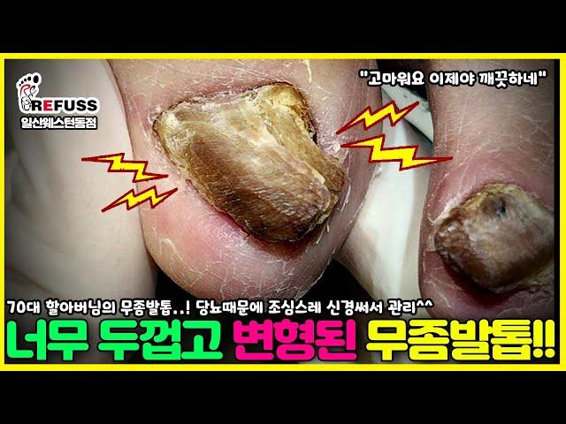 크리스마스의 선물 너무나 두껍고 변형된 무좀발톱 관리하기!!^^ #레푸스 #일산레푸스 #내성발톱 #무좀발톱 #ingrown_toenail #일산내성발톱 #일산무좀발톱 #발톱