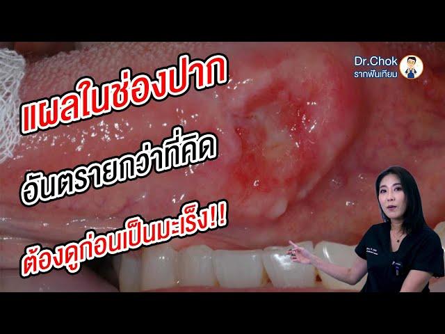 แผลแบบไหน ที่ทำให้เสี่ยง เป็นมะเร็งในช่องปาก ?!! | คลายปัญหาฟันกับทีมหมอโชค