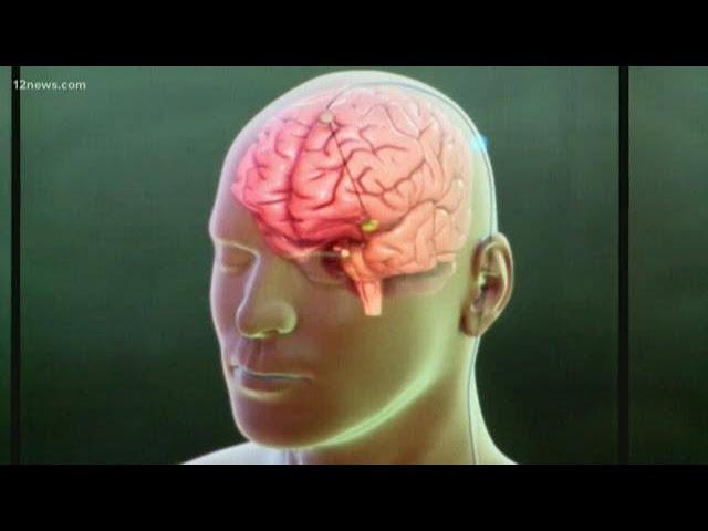 Doctors at Barrow Neurological Institute working on cure for Alzheimer's Disease