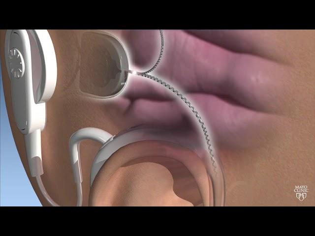 Mayo Clinic Minute: New technology for cochlear implants