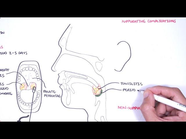 Strep throat (streptococcal pharyngitis)- pathophysciology, signs and symptoms, diagnosis, treatment