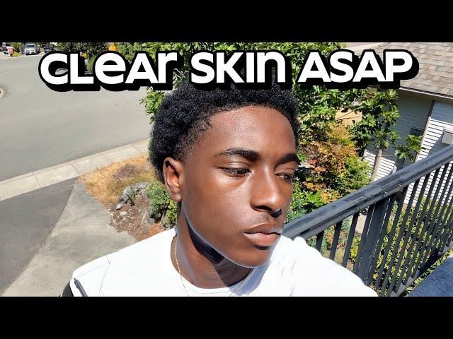 how to get clear skin for guys asap