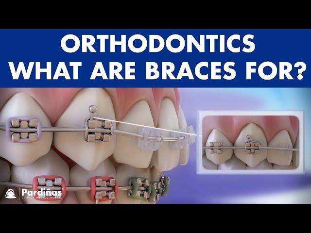 How Braces Work- Elements of the orthodontic treatment and its role ©