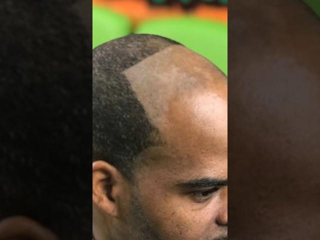 BARBERS STOP PUSHING HAIRLINES BACK ‍️