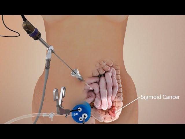 Colon cancer sigmoid colectomy - 3D animation surgical procedure