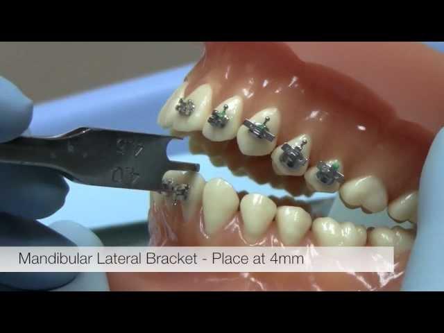 American Orthodontics Alexander LTS Brackets -- Bracket Placement Video