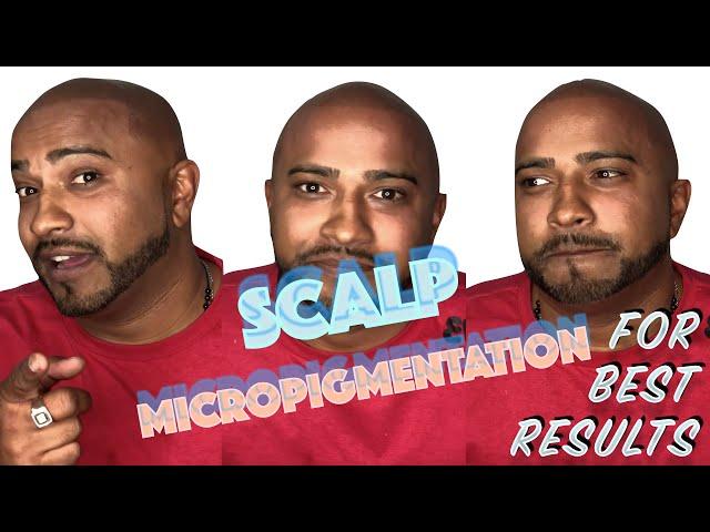 Best Scalp Micropigmentation Results - Ink 2 Scalp Micropigmentation Studios | Ontario