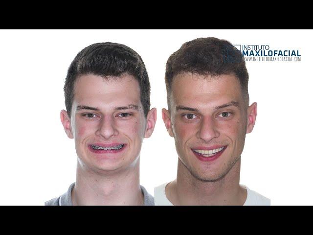 Jaw surgery Case # 105: Gustavo - Short face, overbite, maxilo-mandibular retrusion