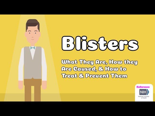 Blisters - What They Are, How they Are Caused, & How to Treat & Prevent Them