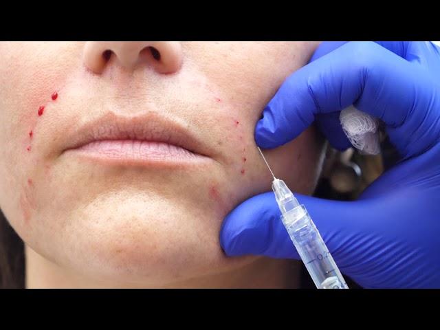 Nasolabial Fold Fillers - Pearlman Aesthetic Surgery