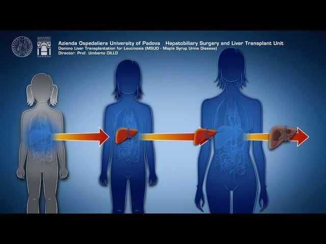 Domino Liver Transplantation for Leucinosis