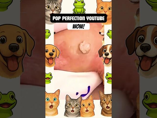 WOW! #pimplepopping #pimple #pimples #shortsfeed #shortvideo #shorts #short #youtubeshorts #youtube