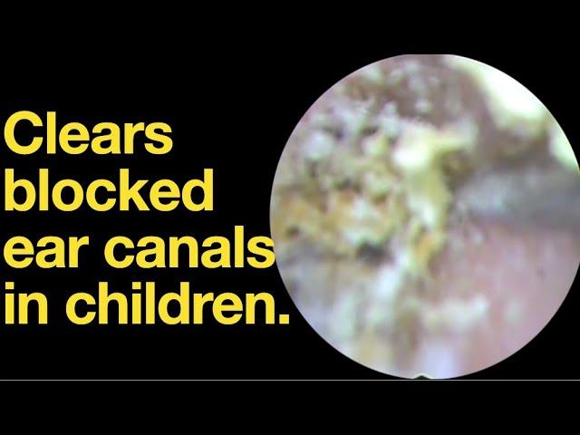 Clears blocked ear canals in children. |ear wax removal | ear cleaning | ASMR | relaxation | relax