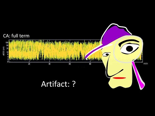 aEEG interpretation