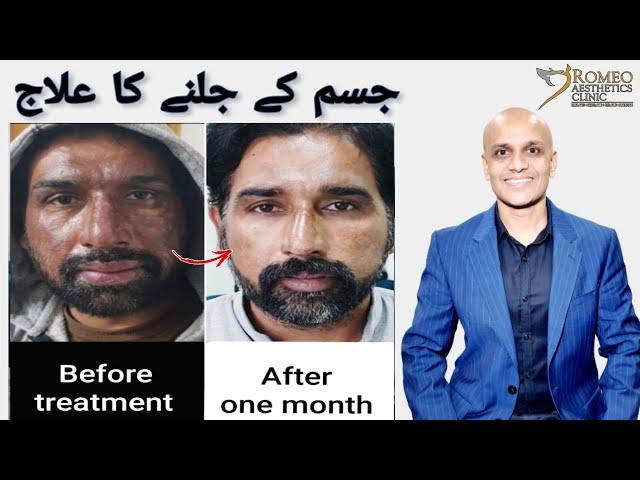 Treatment of face burn | Dr Romeo Rajput