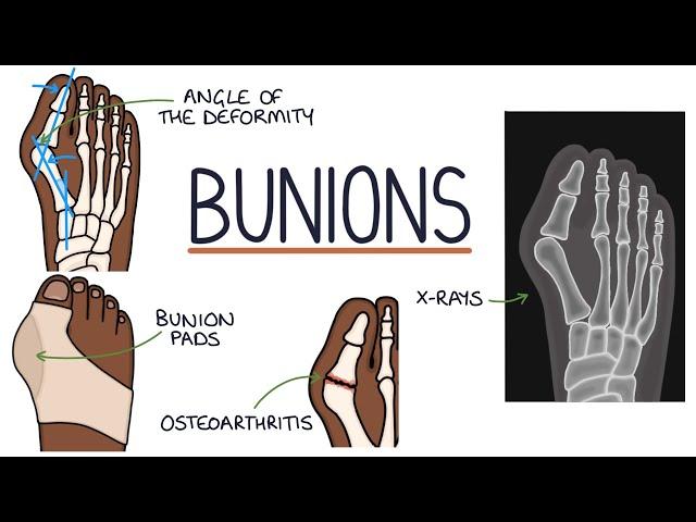 Understanding Bunions (Hallux Valgus)