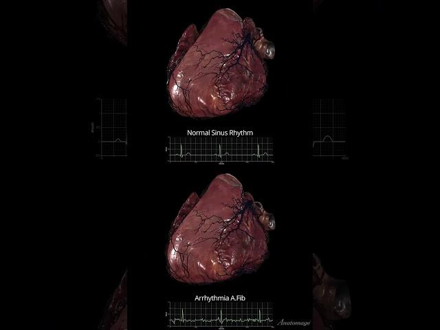 Atrial Fibrillation (AF)