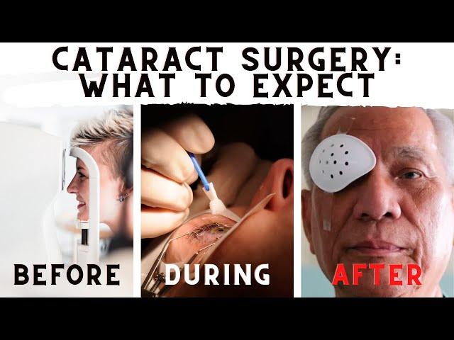 What To Expect Before, During, And After Cataract Surgery!