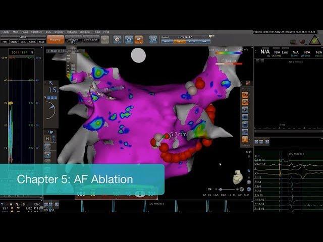 Efficient AF Ablation Workflow With CARTO®3 System And Ablation Index - Chapter 5