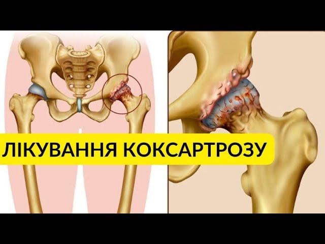 Що таке коксартроз? Комплекс домашніх вправ при коксартрозі